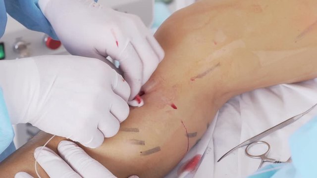 Vascular surgeon performs leg surgery.Varicose veins on the legs.laser coagulation..