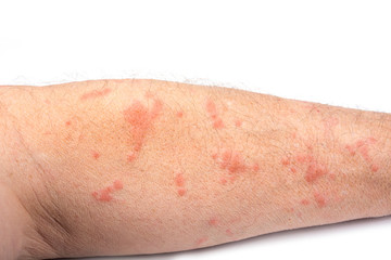 Skin disease rash on a man arm