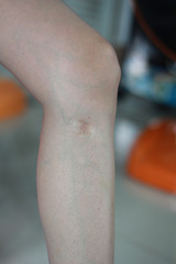 Scars on the skin around the legs, Scar on a girl's leg close-up. Varicose veins from the injury on the leg