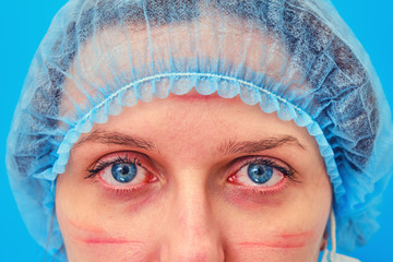 Doctor face with traces and wounds from a medical mask, stay home. Woman nurse on a blue background...