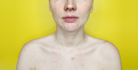Unrecognizable woman with a problem vascular skin yellow background. Acne treatment. Female face with pimples, couperose or rosacea close up. Cosmetology and skin care concept. Copyspace mockup