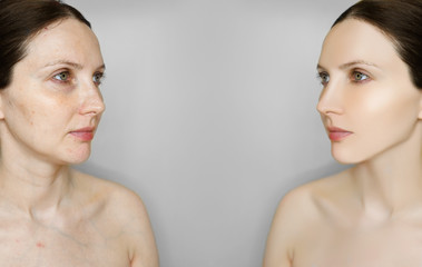 Beautiful woman with a problem vascular skin. Photo before and after acne treatment. Female face...