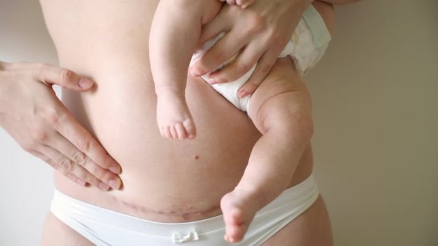 Closeup of woman belly with a scar from a cesarean section. Woman with baby on her hand