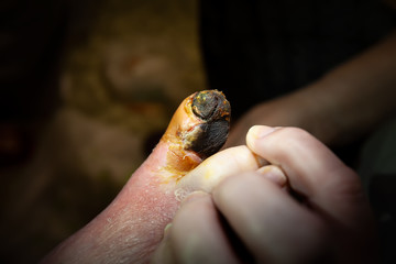 Gangrene of the toe of an old grandmother. Nail blackening, tissue necrosis. Clear boundaries.