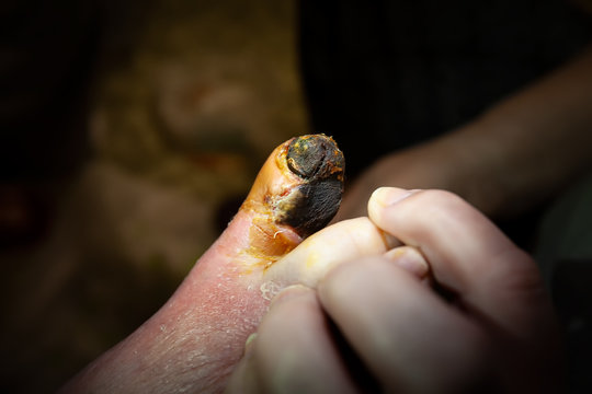 Gangrene of the toe of an old grandmother. Nail blackening, tissue necrosis. Clear boundaries.