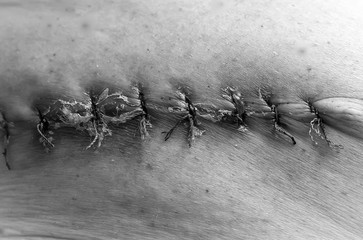 Black and white photography, close-up. Department of Oncology Surgery. A picture of a postoperative medical suture after removal of a malignant tumor - moles. Malignant melanoma.