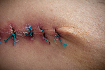 Color photo. Close-up. Department of Oncology Surgery. A picture of a postoperative medical suture...