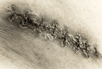 Macro with a close approximation, black and white. Medical scar after surgery after removal of a cancerous tumor - a bad big mole, a color picture, stitches of a seam, a thread with knots.