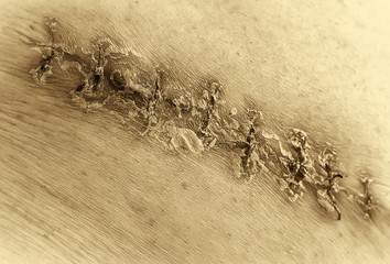 Macro close up, black and white, sepia. Medical scar after surgery after removal of a cancerous tumor - a bad big mole, a color picture, stitches of a seam, a thread with knots.