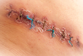 Macro close up. Medical scar after surgery after removal of a cancerous tumor - a bad big mole, a...