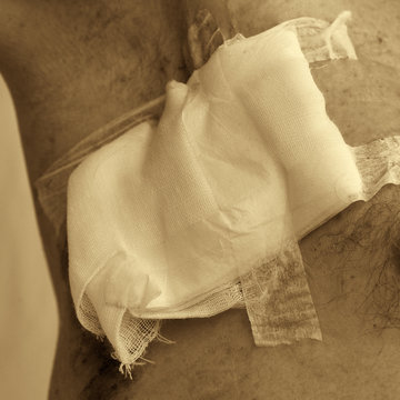 Surgical department of a medical hospital. A snapshot of the dressings imposed on the seam. Surgery to remove the sentinel lymph node in the groin at hand. Black and white image. Sepia.