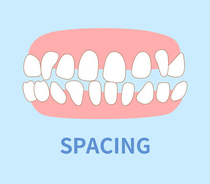 orthodontics  illustrations ; spacing tooth