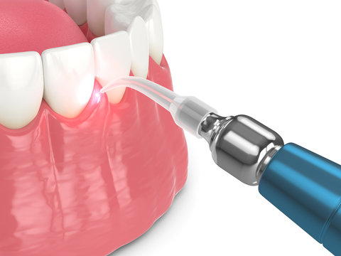 3d render of dental diode laser used to treat gums