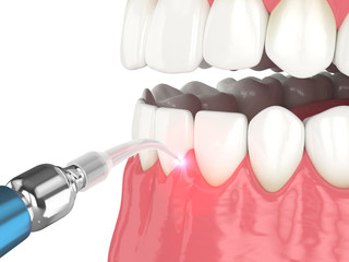 3d render of dental diode laser used to treat gums