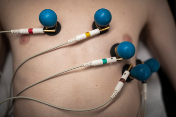 A patient with EKG electrodes attached to his body.