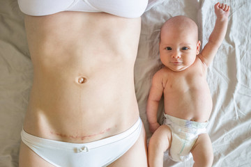 Closeup of woman belly with a scar from a cesarean section and her baby with raised hand near - obrazy, fototapety, plakaty
