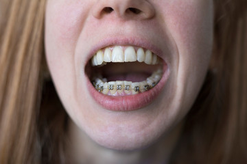 Faceless girl with open mouth with metal braces on the lower jaw close-up. Tooth alignment. Crooked teeth