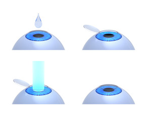 Laser eye surgery procedure. 3D-rendering.