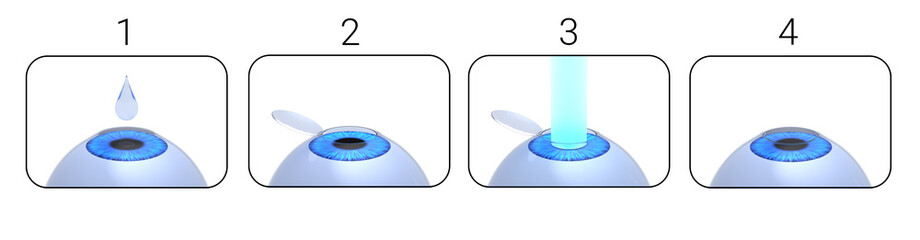 Laser eye surgery procedure. 3D-rendering.