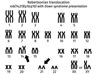 Scheme of Robertsonian thanslocation with clinical presentation of Down syndrome karyotype of human somatic cell 46XX (or 46XY) - 14 + rob(14;21)(q10;q10)