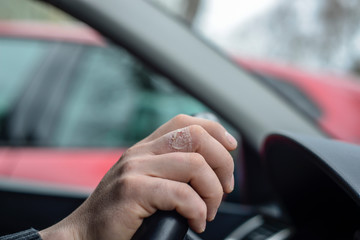 Skin ulcers from oil casually on thumb area