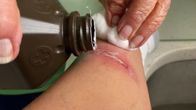 A nurse pours hydrogen peroxide on a leg wound to prevent it from getting infected.  	