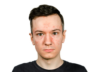 Obraz premium Portrait of man with allergy, with red face, isolated