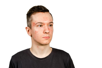 Portrait of young man with allergy, with red face, isolated,