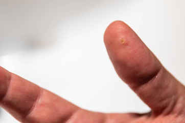 Close up shot of the thumb of the right hand of a Caucasian man suffering from wart. You can notice the circular stain of the infected area.