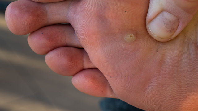 Close up shot of a warty Caucasian man's foot. The fingers of the hand inspect the skin near the infected area.