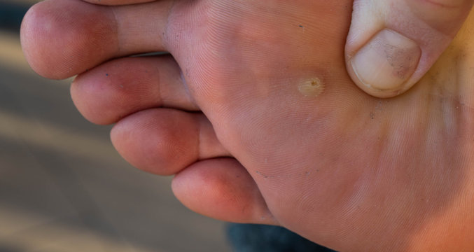Close up shot of a warty Caucasian man's foot. The fingers of the hand inspect the skin near the infected area.