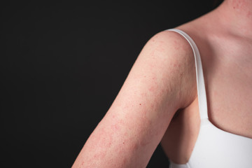 the girl has dermatitis on the arm and shoulder on a black background