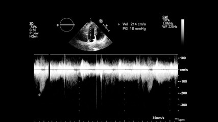 Image of the heart in gray-scale mode during transesophageal ultrasound.