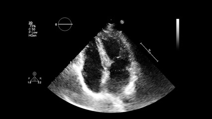 Image of the heart in gray-scale mode during transesophageal ultrasound.