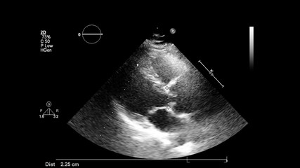 Image of the heart in gray-scale mode during transesophageal ultrasound.