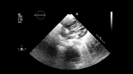 Image of the heart in gray-scale mode during transesophageal ultrasound.