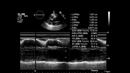 Image of the heart in gray-scale mode during transesophageal ultrasound.