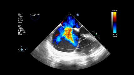 Image of the heart during transesophageal ultrasound with Doppler mode.