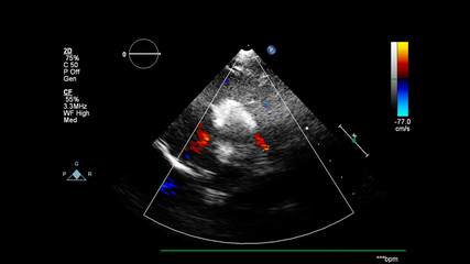 Image of the heart during transesophageal ultrasound with Doppler mode.