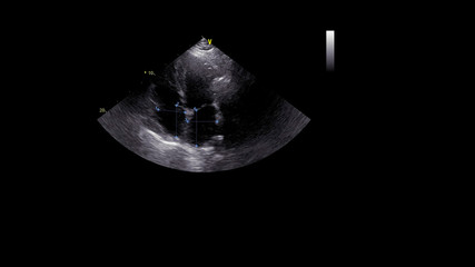 Image of the heart in gray-scale mode during transesophageal ultrasound.