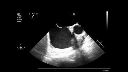 Image of the heart in gray-scale mode during transesophageal ultrasound.