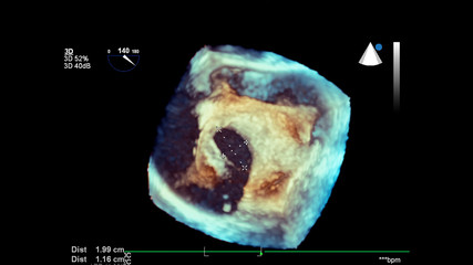 3D image of the heart during transesophageal ultrasound of the heart.