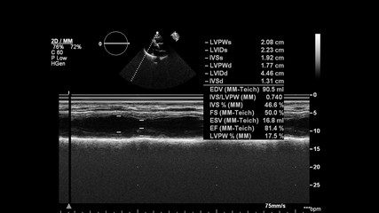 Image of the heart in gray-scale mode during transesophageal ultrasound.
