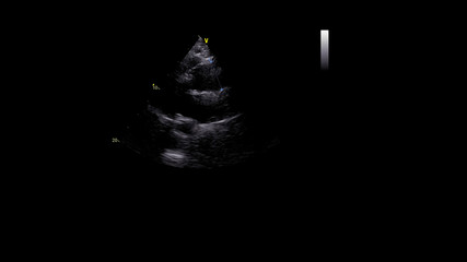 Image of the heart in gray-scale mode during transesophageal ultrasound.
