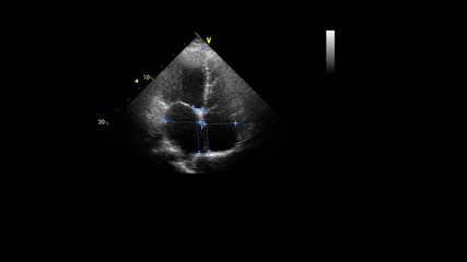 Image of the heart in gray-scale mode during transesophageal ultrasound.
