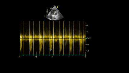 Image of the heart in gray-scale mode during transesophageal ultrasound.
