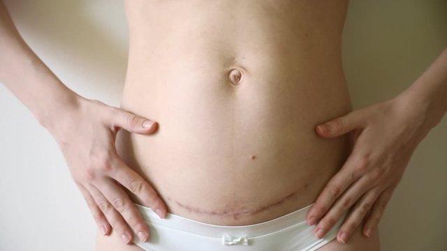 Closeup of woman belly with a scar from a cesarean section, white bckground and nature light