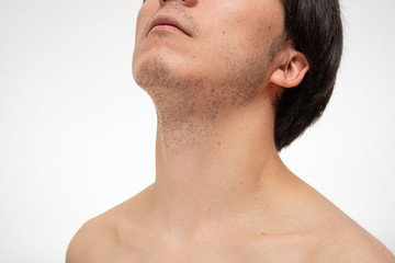 髭脱毛　beforeイメージ　3日間処理してない髭