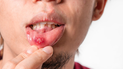 Asian man have aphthous ulcers on mouth on white background, selective focus.