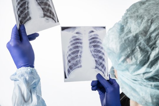 Lung x-ray covid-19 hospital medical, health.